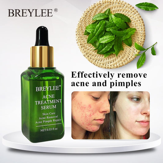 BREYLEE Acne Treatment Facial Serum